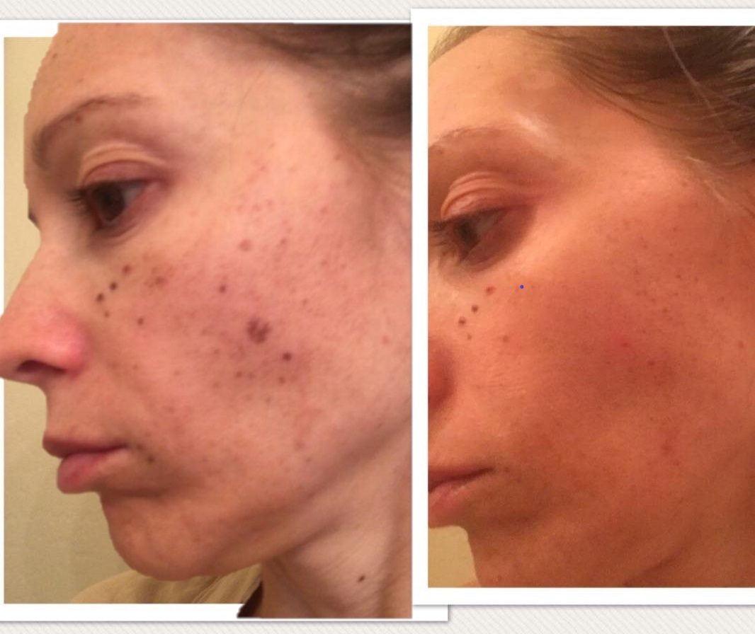 PhotoFacial, BBL, Acne, laser, skin, antiaging, agespots, scars, wrinkles