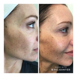 NEOS Med Spa-Tempe-Photofacial-before&after