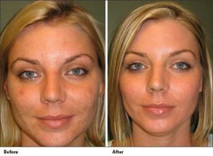 microdermabrasion results